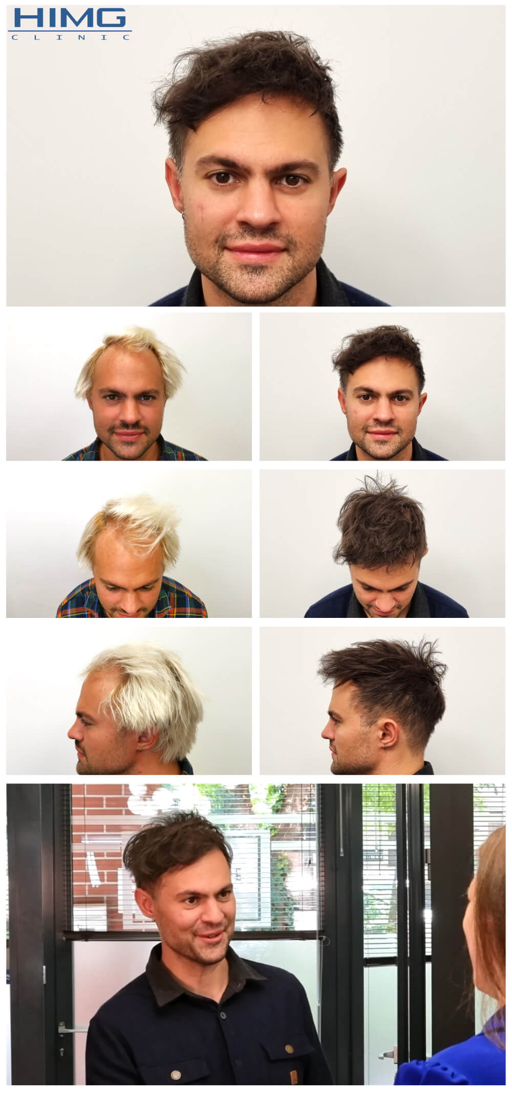 Hajbeültetés eredménye: Novkov Máté - HIMG hajbeültetési klinika