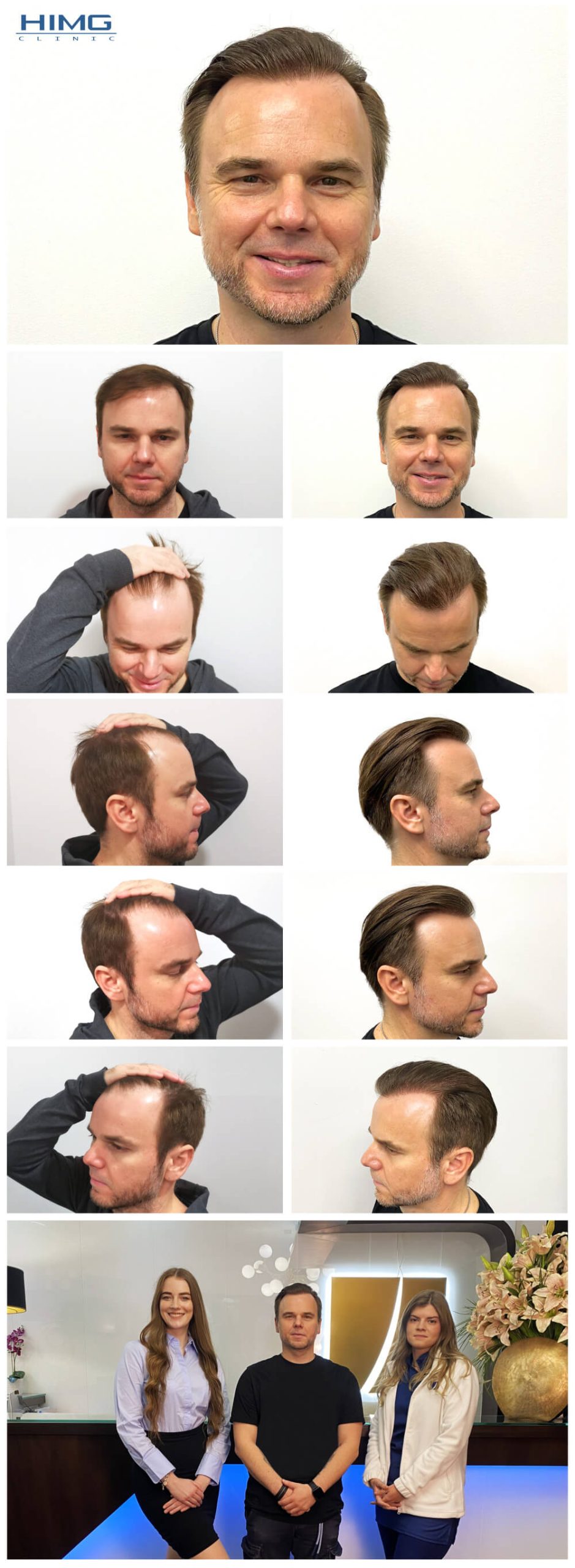 Hajbeültetés előtte-utána - Juhász Gergely - HIMG Hajbeültetési Klinika