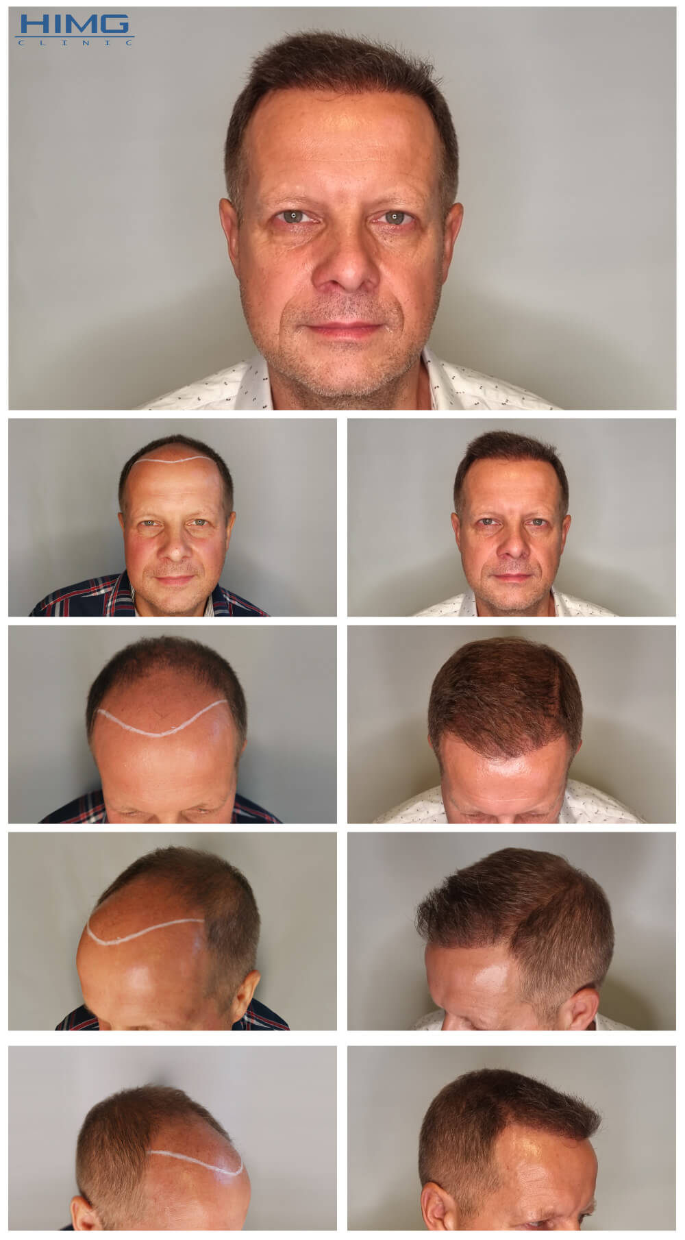 Hajbeültetés előtte-utána: Marcel - HIMG hajbeültetési klinika