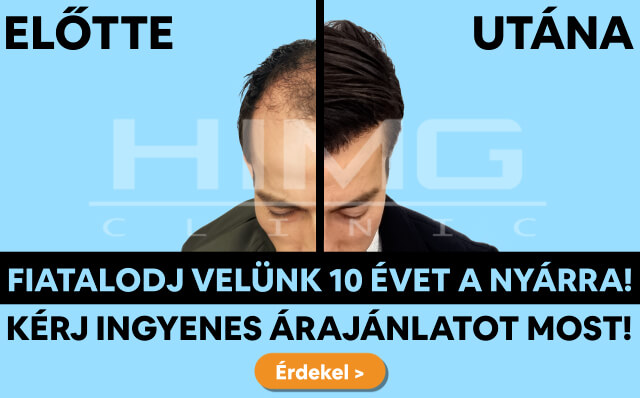 HIMG hajbeültetés akció