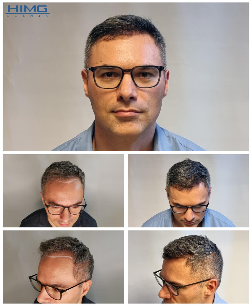 Hajbeültetés előtte-utána: Pavel - HIMG hajbeültetési klinika