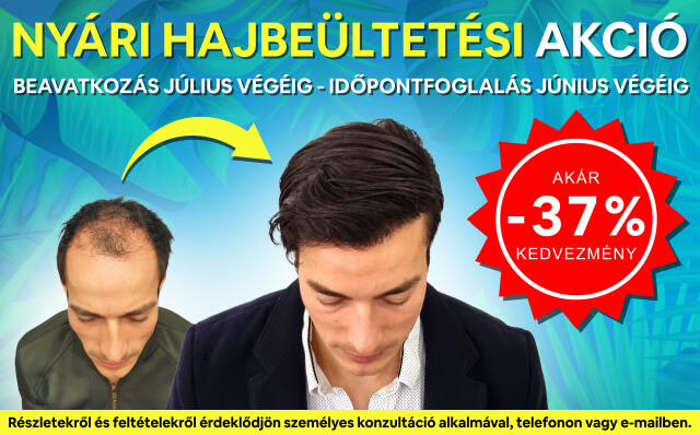 HIMG hajbeültetés akció