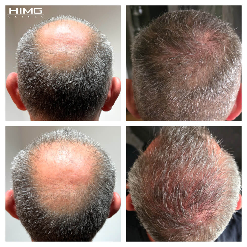 Hajbeültetés előtte-utána: Markus - HIMG hajbeültetési klinika